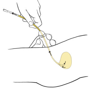 15.Hand draining bladder with urinary catheter in place-boy