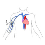 304.Central catheter with peripheral access on child.FINAL