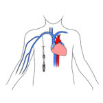 305. Central catheter inserted in child.FINAL