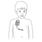 307.Catheter central implantable chamber on child.FINAL