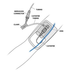 309e.Venous access device