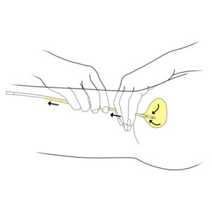 7.Hand draining bladder with urinary catheter in place-girl