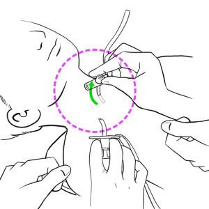 Removal of old cannula